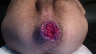 22yo Brazilian Boy Fingering Rosebud (Extreme Wrecked Prolapse Cunt)